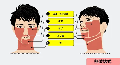 ヒゲ脱毛顔全体プラン